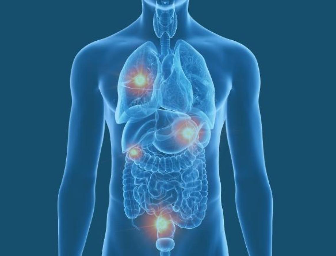 Cancro metastatico, la scienza avanza e iniziano grandi speranze